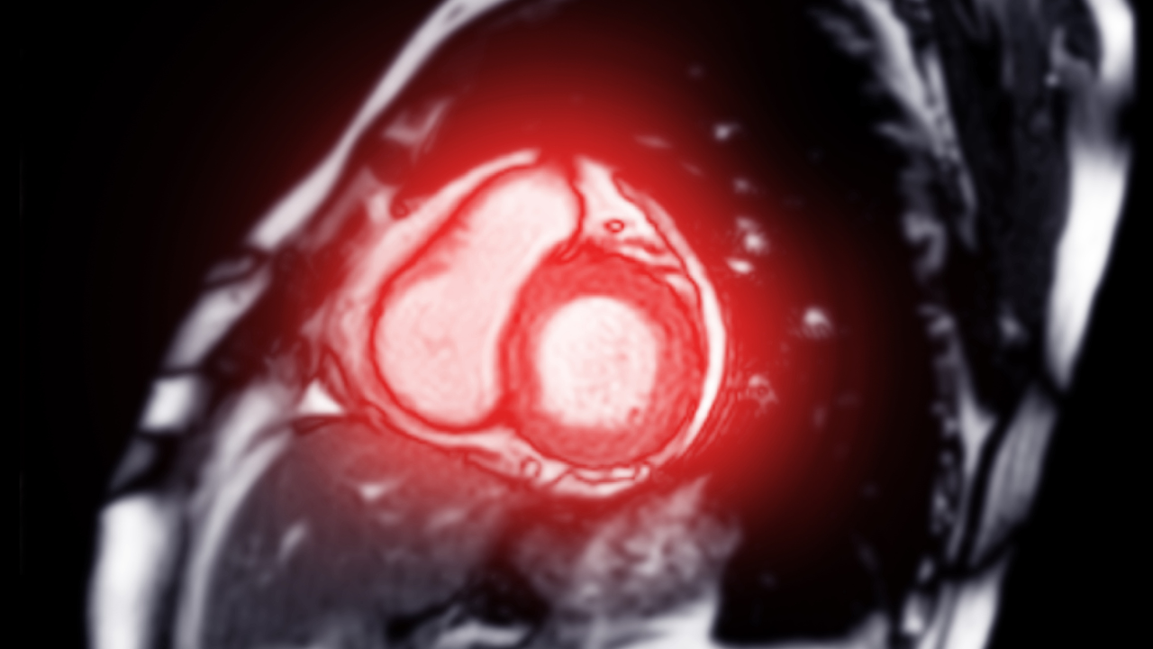 FDA Approves Evolut TAVR System, Medtronic’s Treatment for Symptomatic Severe Aortic Stenosis